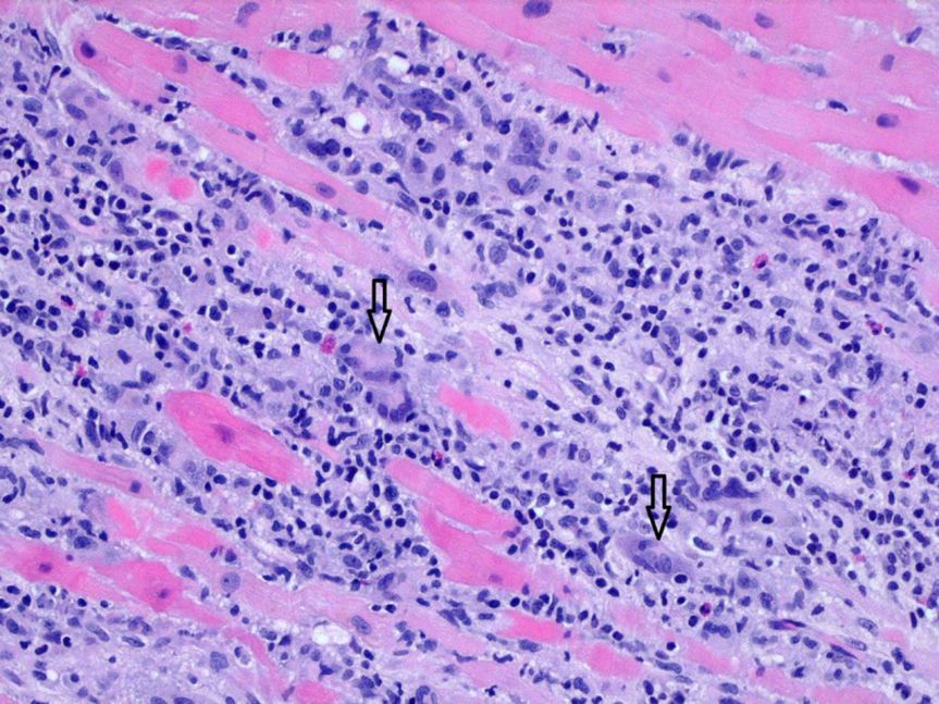 giant cell myocarditis – rare, devastating, and unrelated to GCA